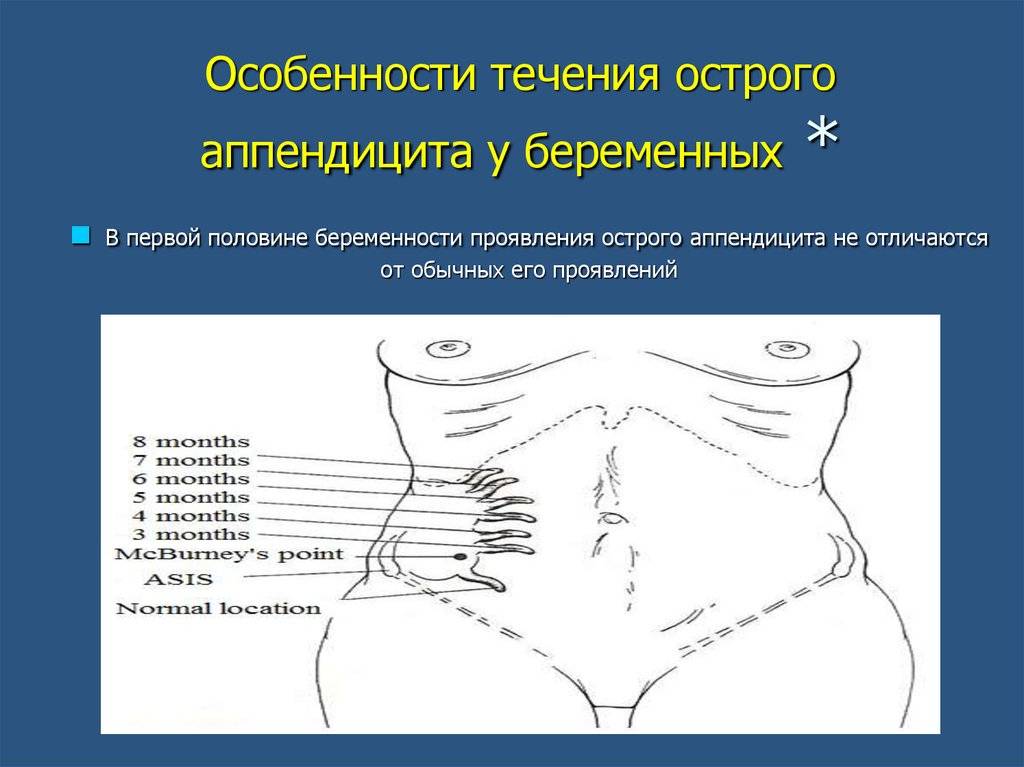 Проблемы диагностики и лечения аппендицита у беременных