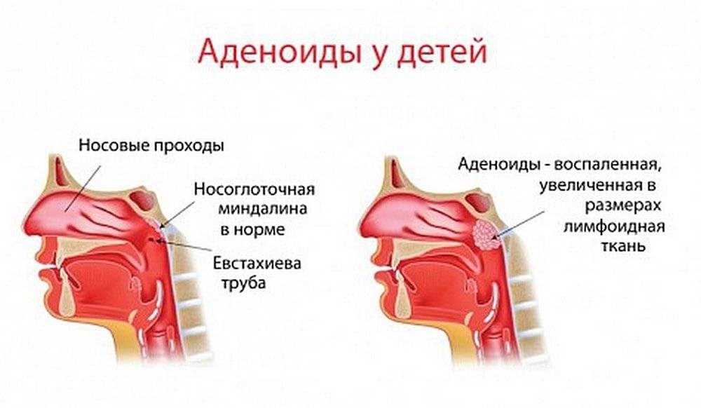 Увеличенные миндалины у ребенка - о чем свидетельствуют?