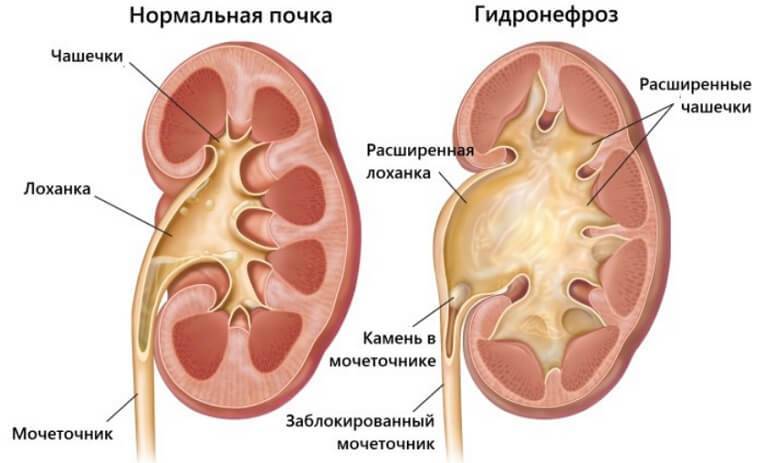 Что такое лоханка почки у взрослого человека фото