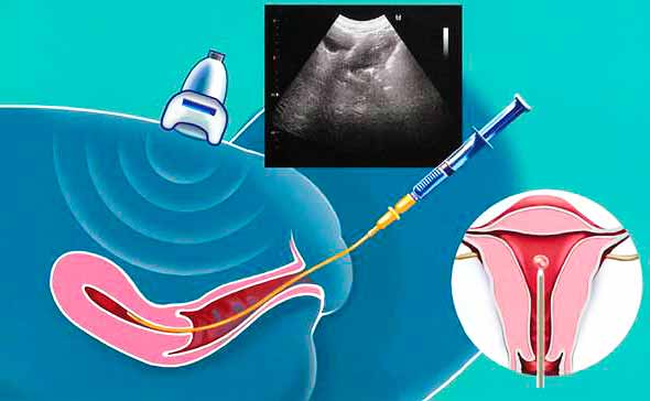 Перенос эмбрионов в полость матки: что это такое, как делается