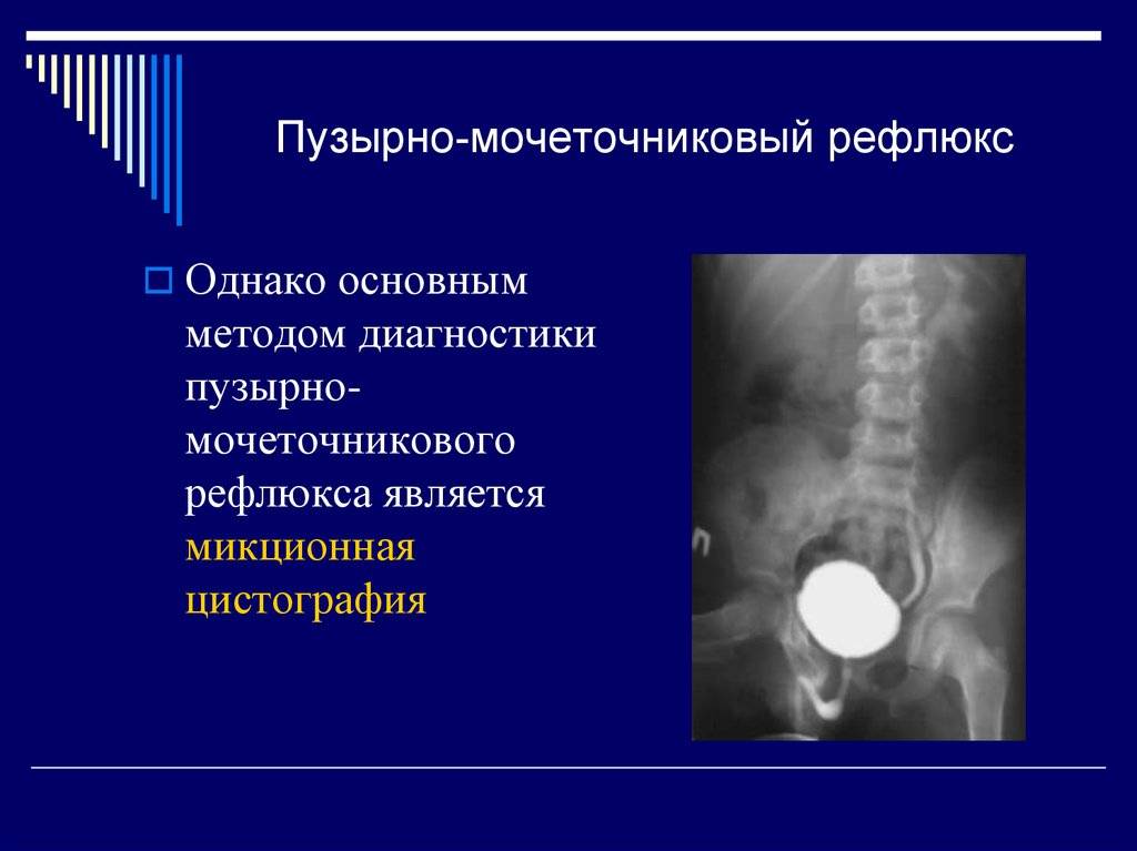 Пузырно мочеточниковый рефлюкс презентация