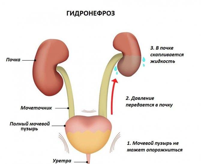 Пиелоэктазия у детей — лечение, диагностика, симптомы и причины болезни | николаев в.в.