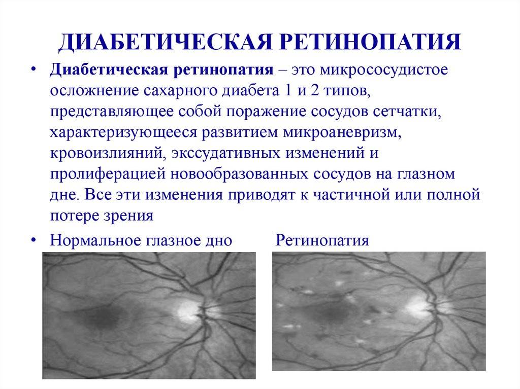 Фоновая (вторичная) ретинопатия лечение в москве