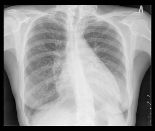 Как выглядит пневмония на снимке рентгена: все виды, отличительные признаки
