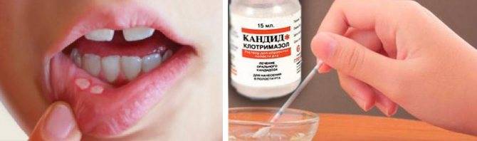 Стоматит: как лечить, виды и лечение