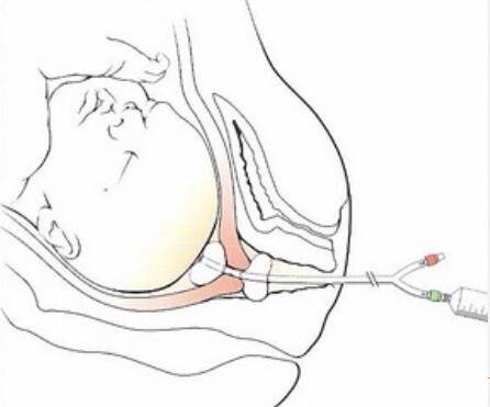 Катетер в матку для стимуляции родов - все о беременности