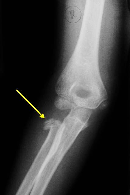 Перелом лучевой кости руки (перелом луча в типичном месте)
