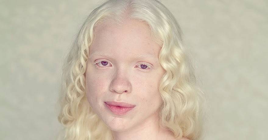 Альбинизм [lifebio.wiki]