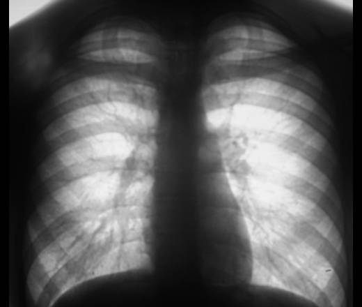 Рентген органов грудной клетки (рентген легких, флюорография)