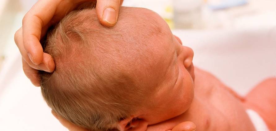 Ребенок родился с маленьким родничком. причины и последствия маленького размера родничка у новорожденного ребенка