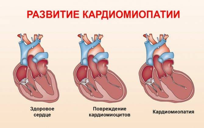 Диагностика дилатационной кардиомиопатии у детей