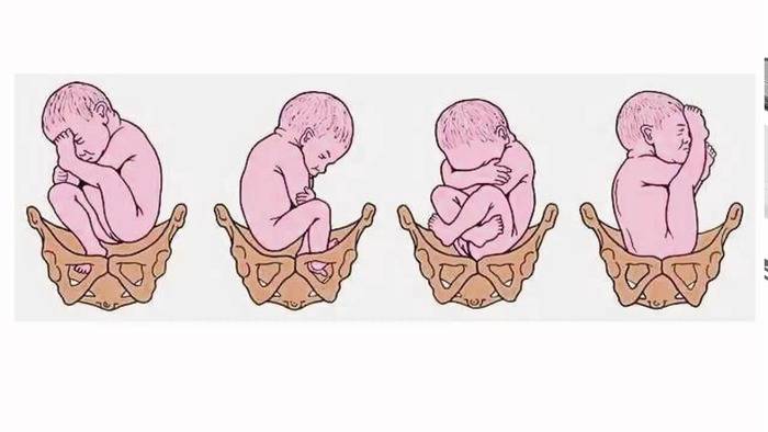 Гимнастика для беременных чтобы перевернулся плод