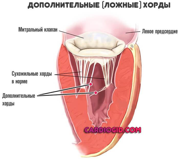 Дополнительная хорда левого желудочка: опасно ли это?