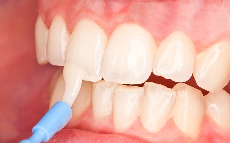 Фторирование зубов - показания и методы