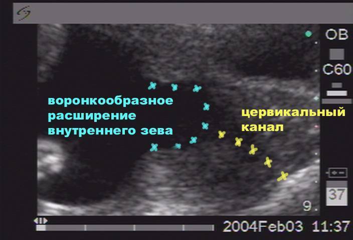 Варикозное расширение вен малого таза у женщин как одно из проявлений дисплазии соединительной ткани.
 - vmc verte medical clinic
