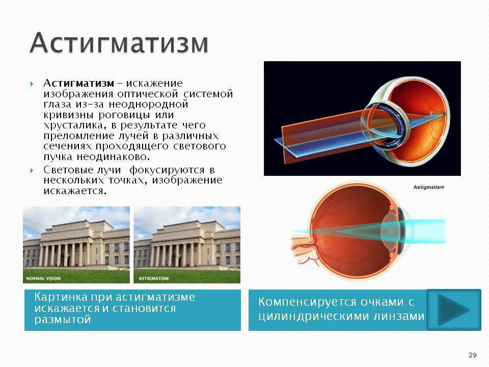 Глазное заболевание астигматизм: лечение - энциклопедия ochkov.net