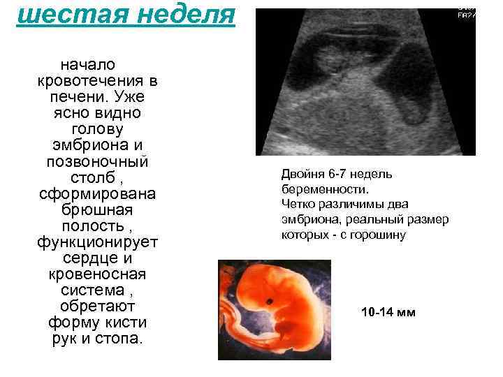 Кровотечение на ранних сроках беременности. Кровотечение на 6 неделе беременности. 6 Недель кровотечение при беременности. 6 Недель беременности идет кровь.