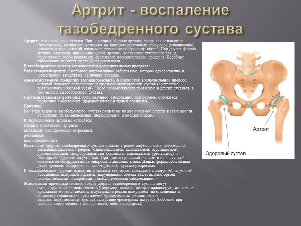 Изменения костей таза. Плазмоцитома тазобедренного сустава. Дисплазия коксартроз тазобедренного сустава. Артрозо артрит 3 степени тазобедренного сустава. Артрит тазобедренного сустава симптомы.