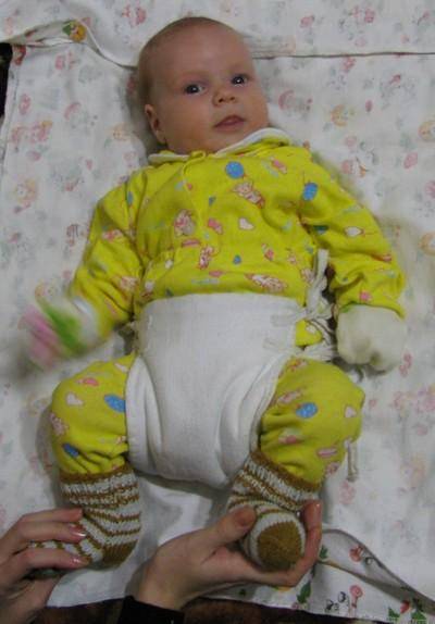 Широкое пеленание новорожденного при дисплазии тазобедренных суставов