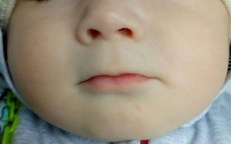 У ребенка синеет носогубный треугольник – причины посинения у грудничка при плаче