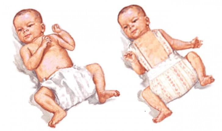 Польза широкого пеленания новорожденных при врожденной дисплазии тбс