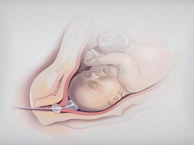 Катетер фолея для стимуляции родов