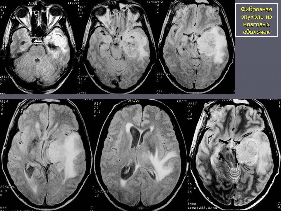 Опухоли головного мозга у детей - симптомы болезни, профилактика и лечение опухолей головного мозга у детей, причины заболевания и его диагностика на eurolab