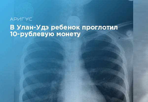 Проглотил монету 1 рубль что делать. Ребёнок проглотил монету. Ребенок проглотил 5 рублей. Ребенок 5 лет проглотил монету. Что делать если ребёнок проглотил монетку.