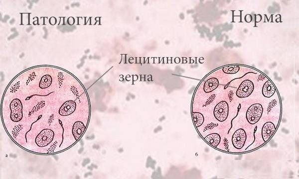 Эритроциты, лецитиновые зерна и клетки эпителия в спермограмме: что это означает?
