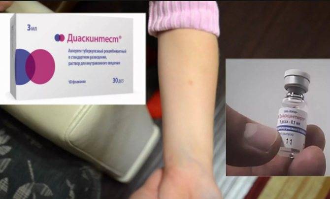 Диаскинтест с какого возраста можно делать детям в россии - медицинский портал