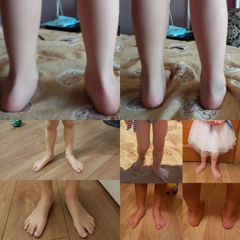 Что вызывает и как исправить деформацию стопы у ребенка?