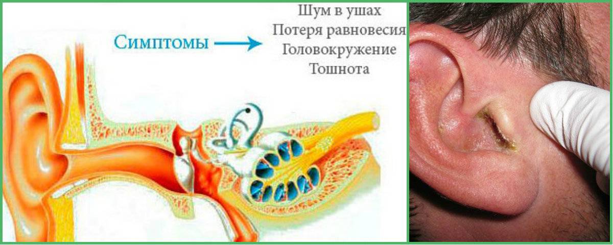 Боль и воспаление в ухе — что может вызвать данный симптом – лечение в цэлт