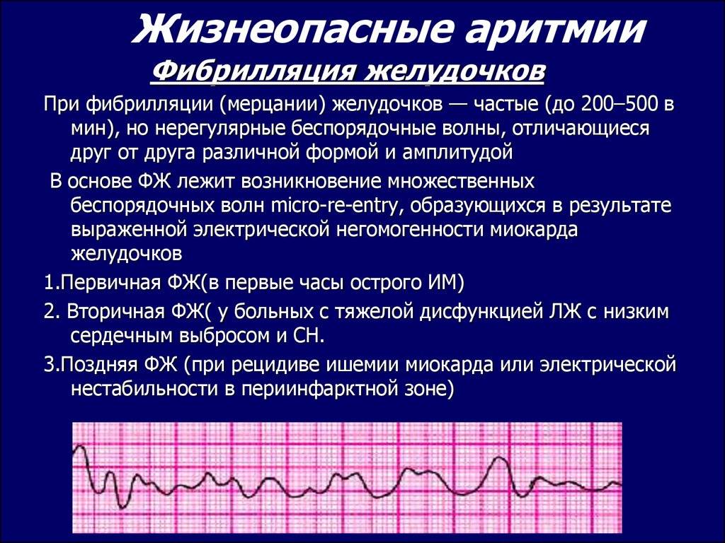 Экстрасистолия