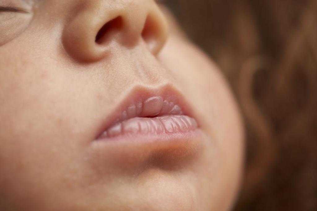 Почему у ребенка опухла губа и что делать? | компетентно о здоровье на ilive