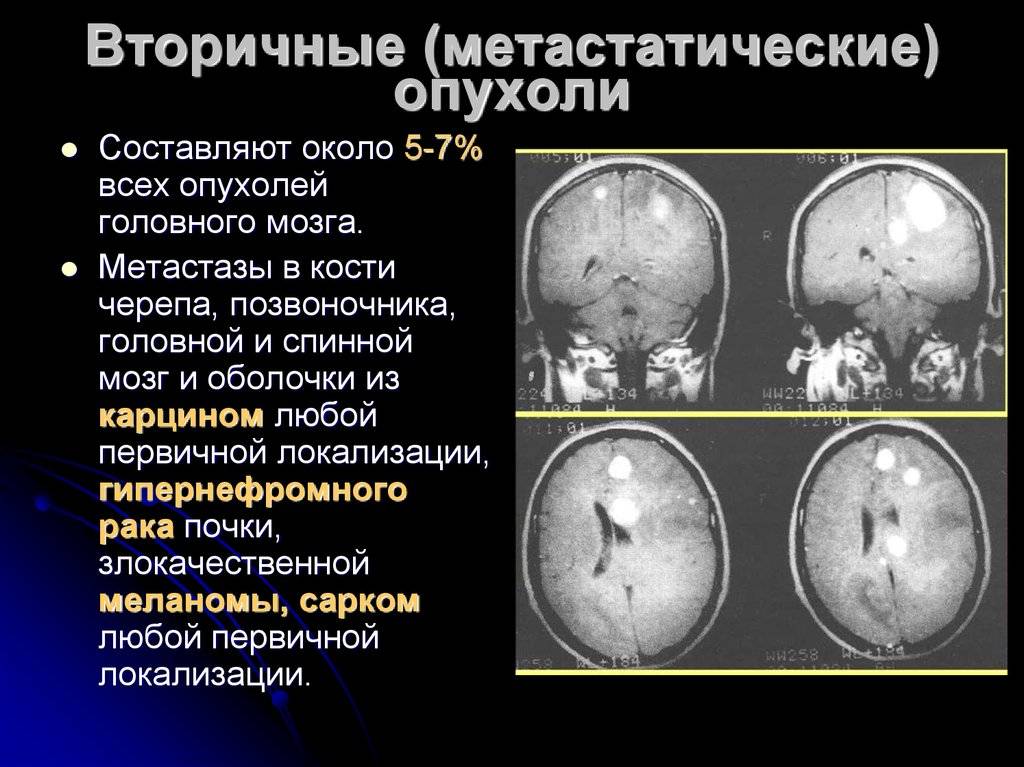 Опухоль мозга у ребенка: как ее распознать и что делать