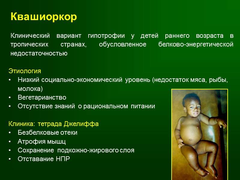 Причины и признаки белково-энергетической недостаточности, гипотрофии, у детей
