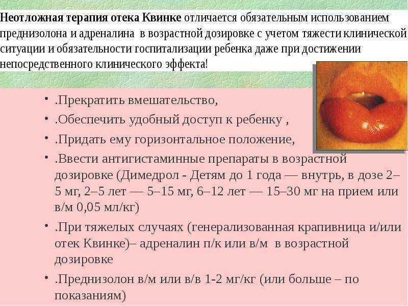 Отек квинке у детей - симптомы болезни, профилактика и лечение отека квинке у детей, причины заболевания и его диагностика на eurolab