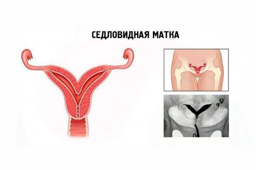Двурогая матка и беременность | компетентно о здоровье на ilive