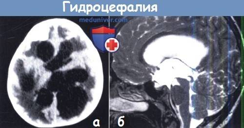 Цереброваскулярная патология | нейродети