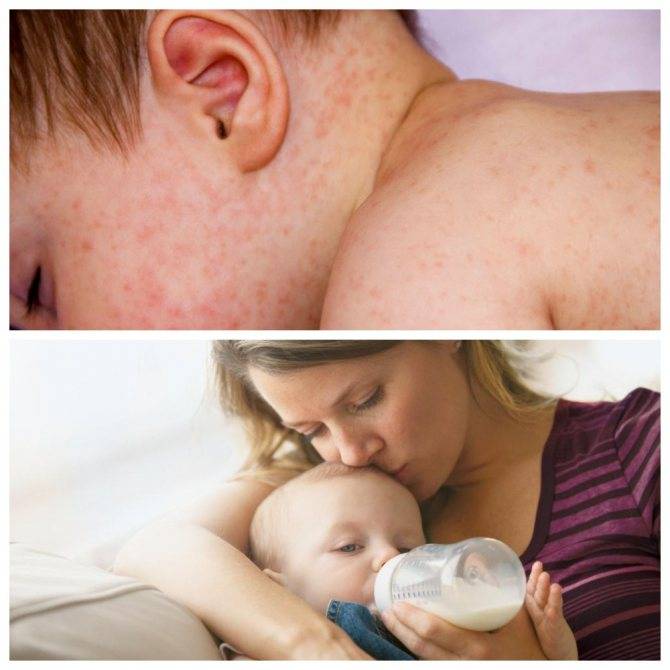 Аллергия на творог: причины, симптомы, лечение | компетентно о здоровье на ilive