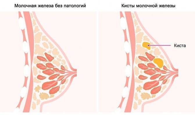Эндометриоз во время климактерия