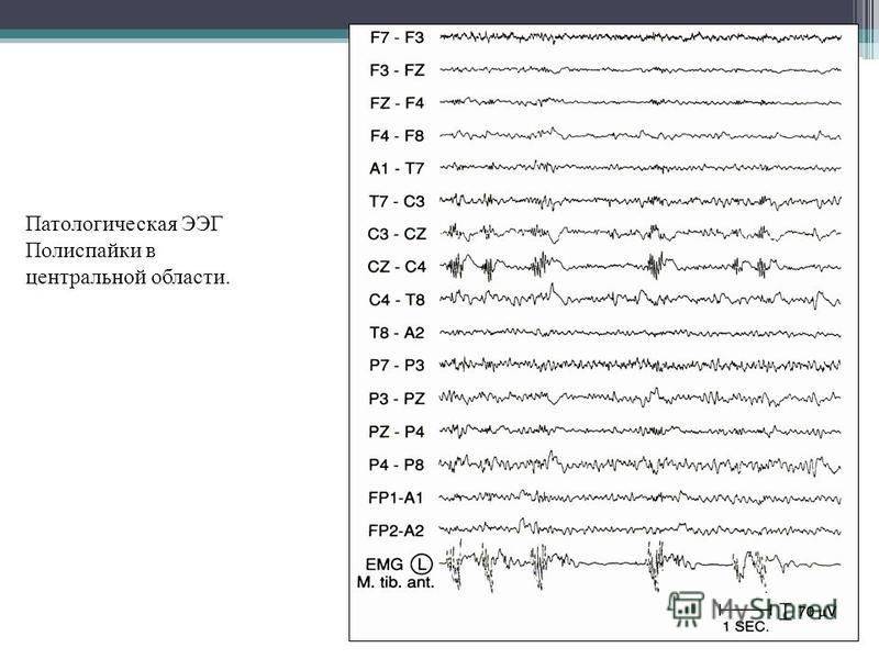 Показатели ээг. Исследование головного мозга ЭЭГ. Расшифровка электроэнцефалограммы головного мозга норма. Нормальная диаграмма ЭЭГ. Патологическая активность на ЭЭГ что это.