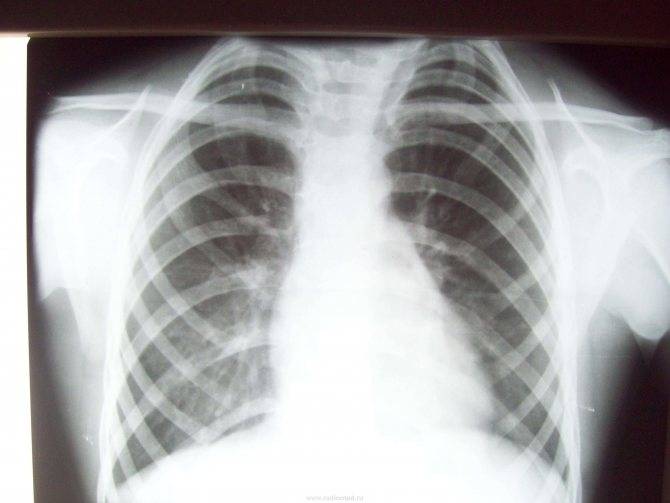 Рентген легких (грудной клетки) в свао москвы