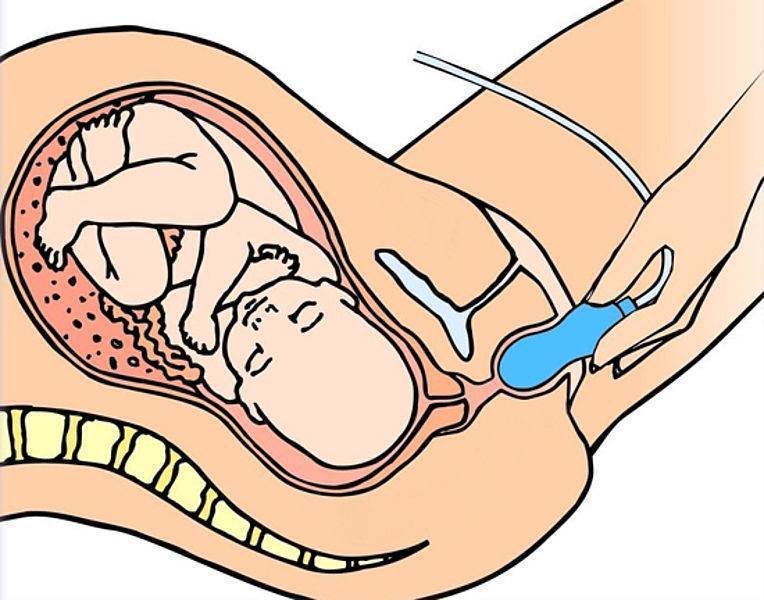 Меньшее «зло»: стимуляция родов vs кесарево сечение?