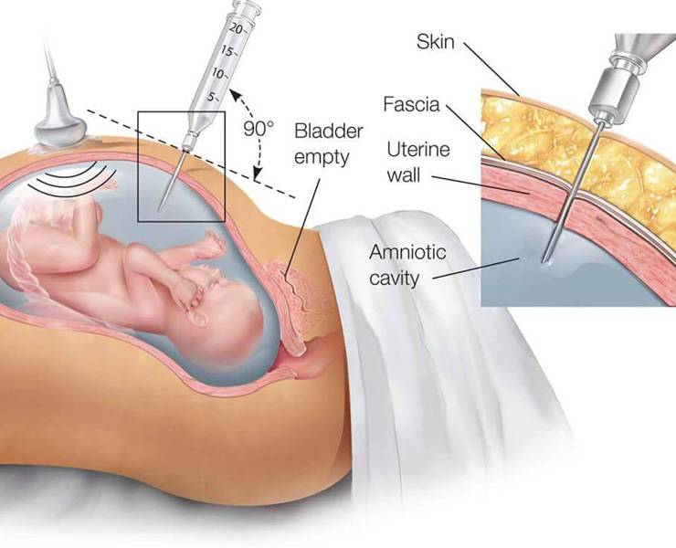 Как понять, что у беременной отошли воды, и что при этом делать?