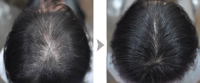 ᐈ выпадение волос у женщин: причины и методы лечения