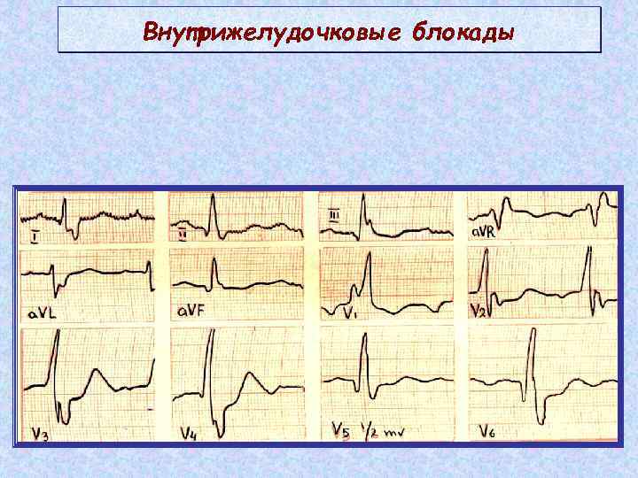 Нарушение внутрижелудочковой проводимости сердца: что это такое, виды, лечение | osostavekrovi.com