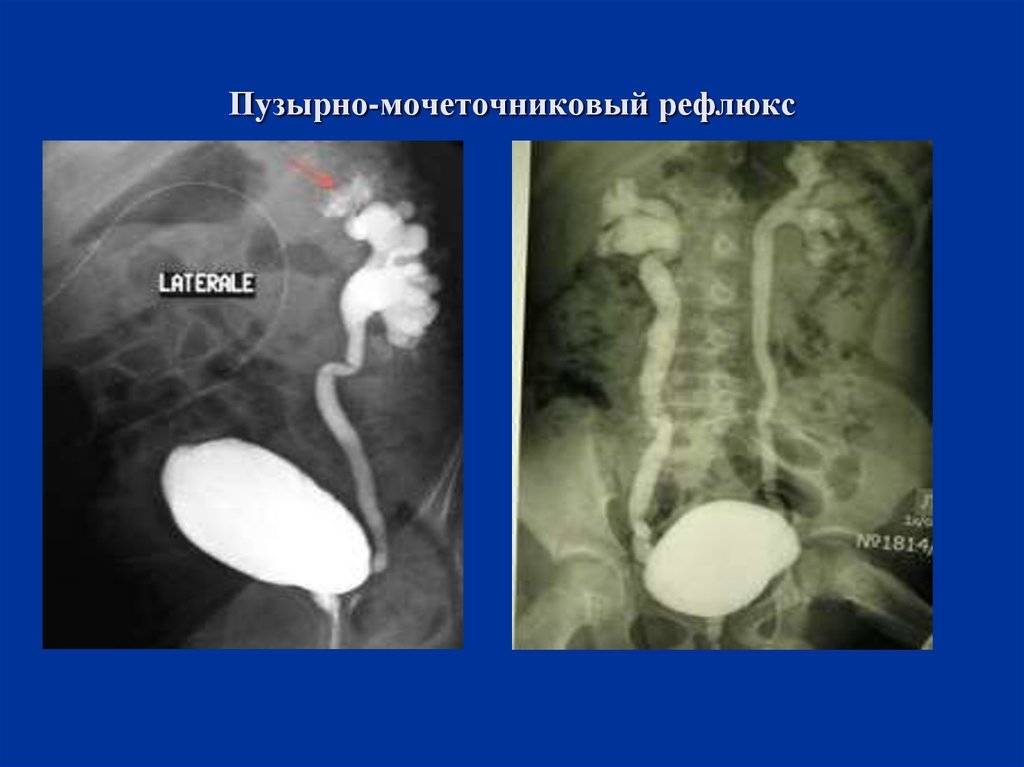 Рефлюкс у детей. Пузырно-мочеточниковый рефлюкс рентген. Мочеточниково-пузырный рефлюкс. Первичный пузырно-мочеточниковый рефлюкс вызван:. Почечно мочеточниковый рефлюкс рентген.