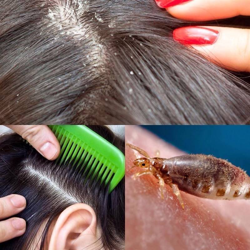 Как избавиться от гнид на длинных волосах?