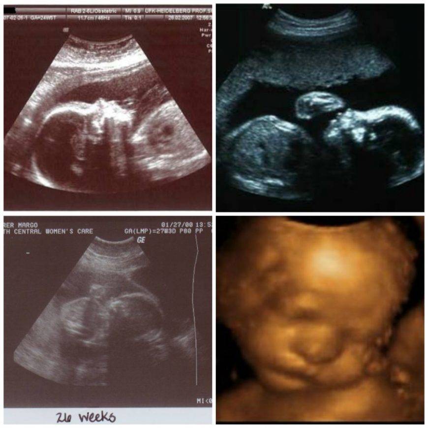 21 неделя беременности - определение пола, отеки ног, набухание груди, зуд, фото живота и ребенка, шевеления